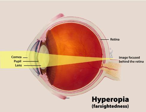 farsighted